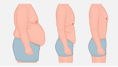 Abdominal Skin Laxity