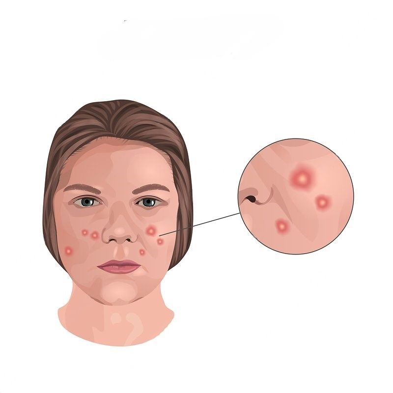 Acne Vulgaris