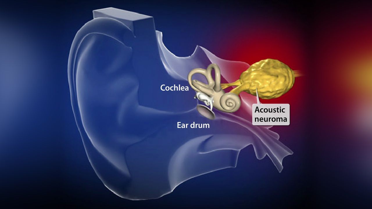 Acoustic Neuroma