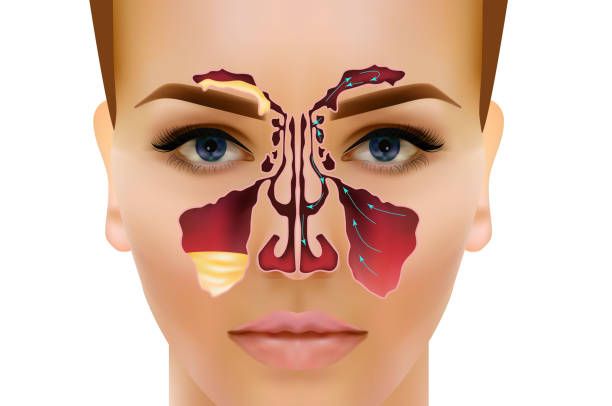Acute Sinusitis