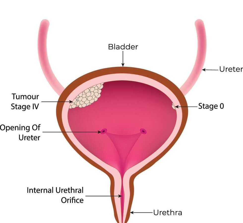 Bladder Cancer