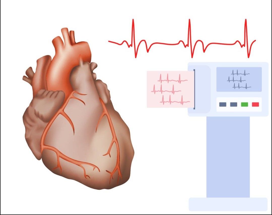 Bradycardia (Slow Heart Rhythm)