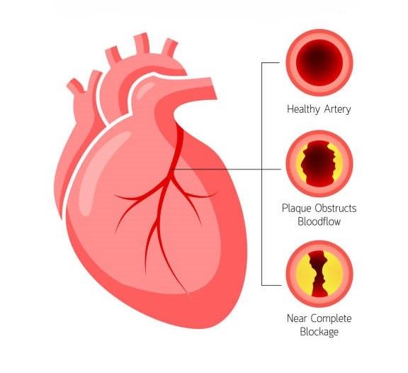 Coronary Artery Disease
