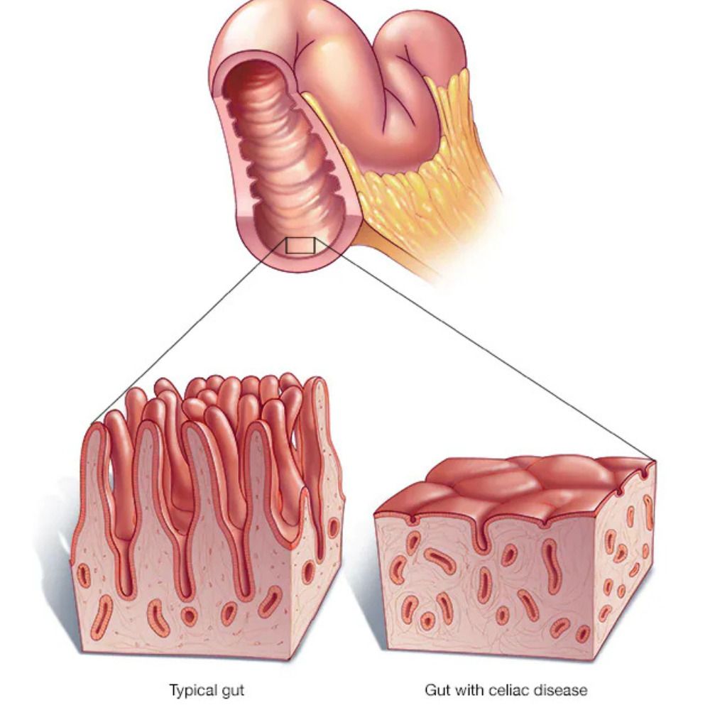 Celiac Disease