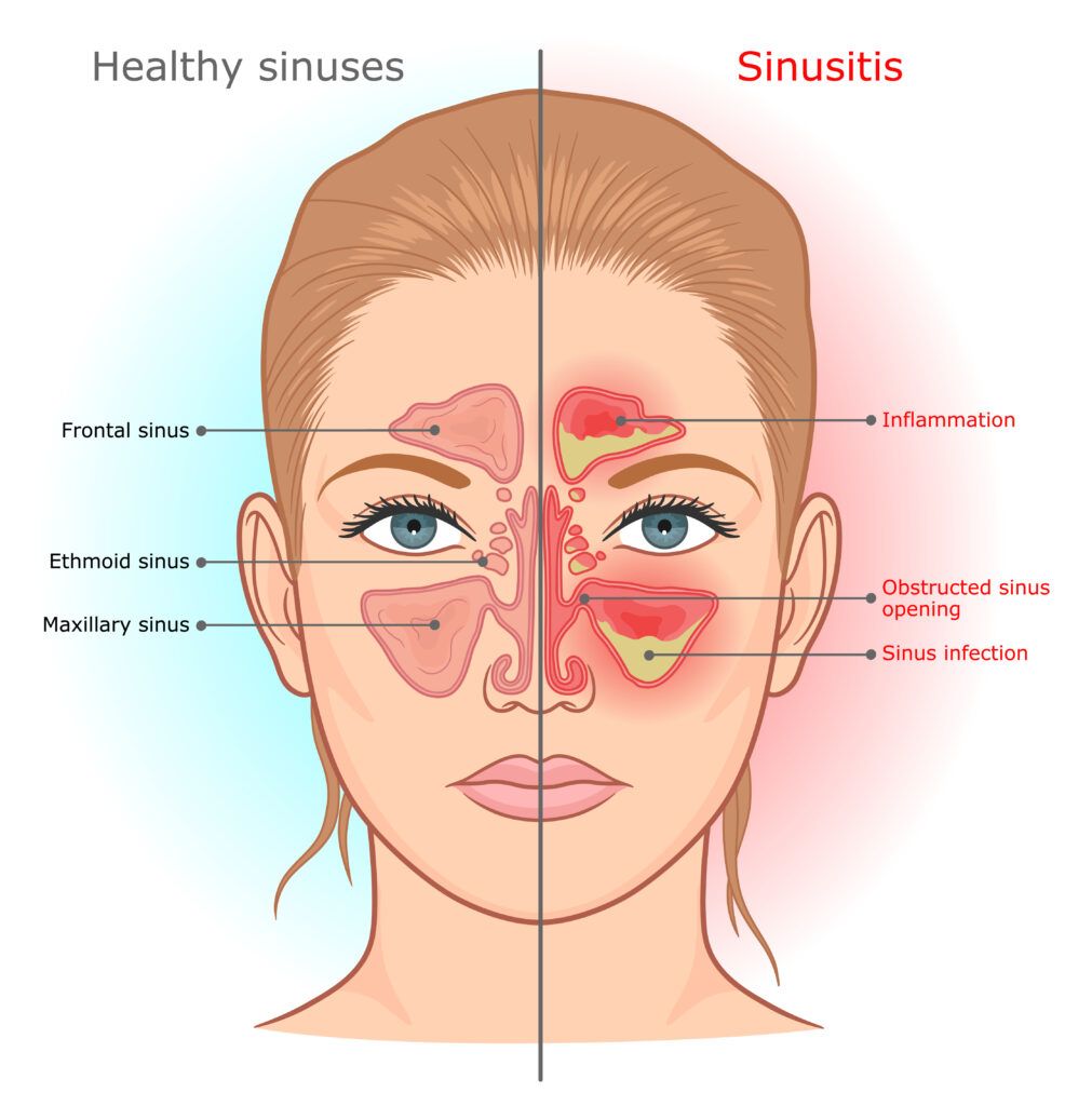 Chronic Sinusitis
