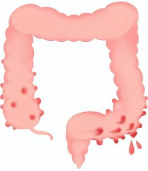 Diverticulitis