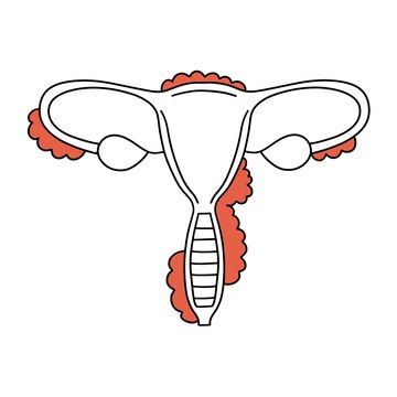 Endometriosis