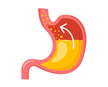 GERD (Gastroesophageal Reflux Disease)