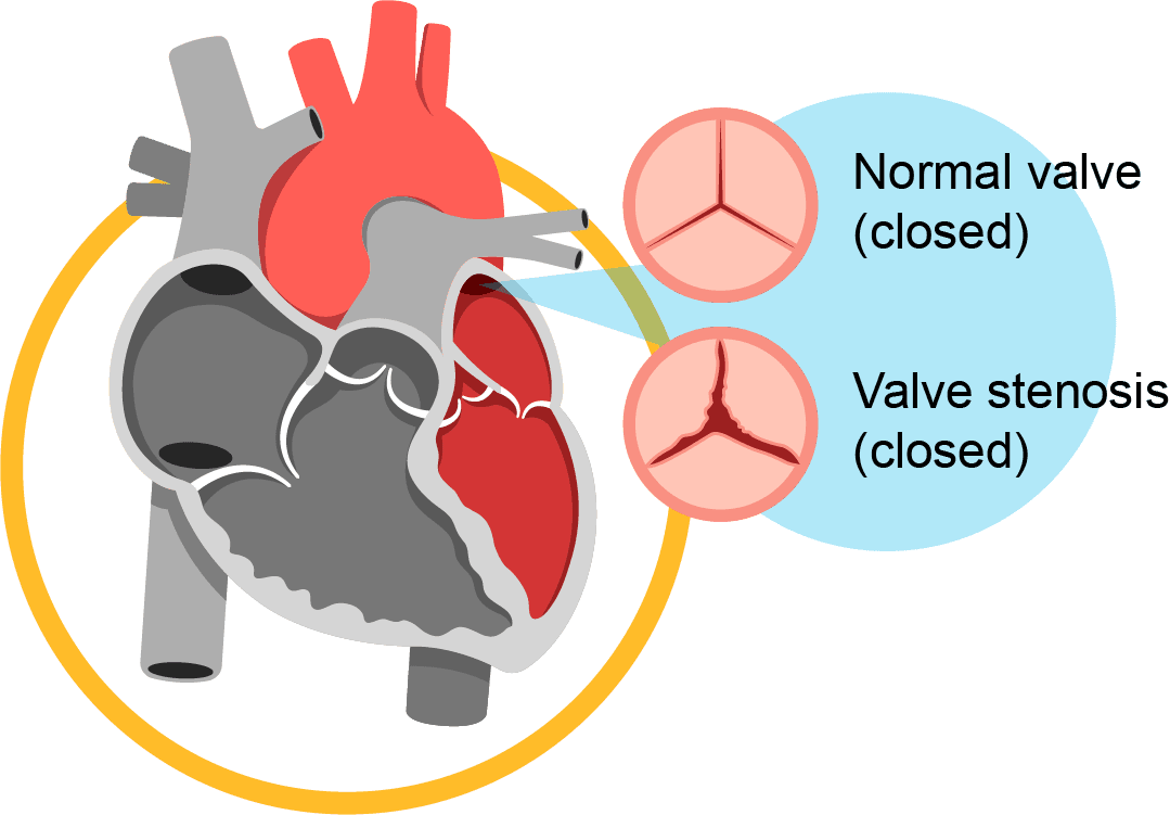 Heart Valve Disease