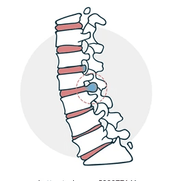 Herniated Disc