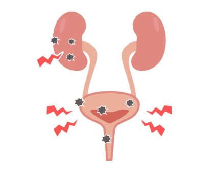 Interstitial Cystitis