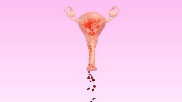 Menorrhagia (Heavy Menstrual Bleeding)