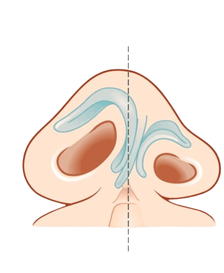Nasal Deformities