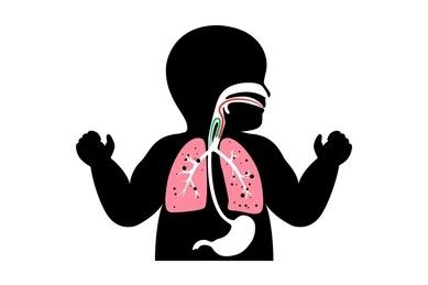 Pediatric Pneumonia
