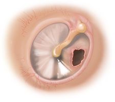 Perforated Eardrum