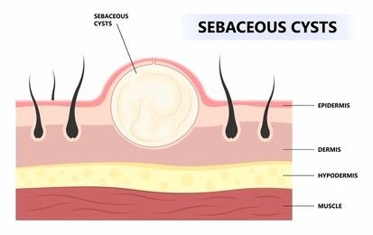 Sebaceous Cysts