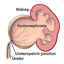 Ureteropelvic Junction (UPJ) Obstruction