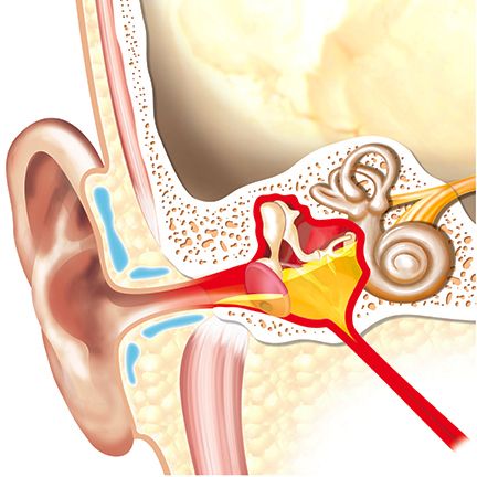 Chronic Ear Infections