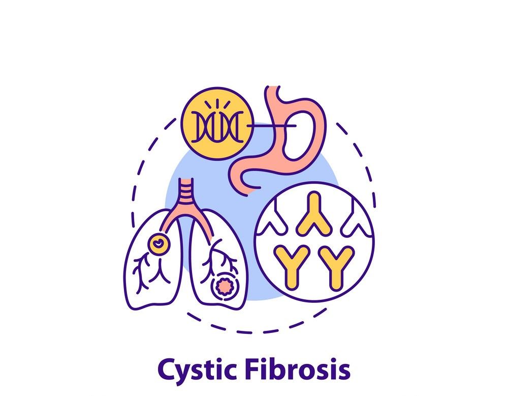 Cystic Fibrosis – Understanding the Genetic Disorder and Its Management