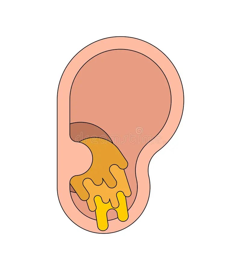 Earwax Impaction