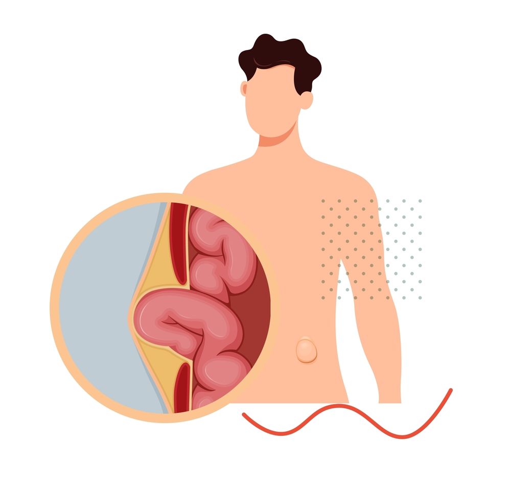 Hernias