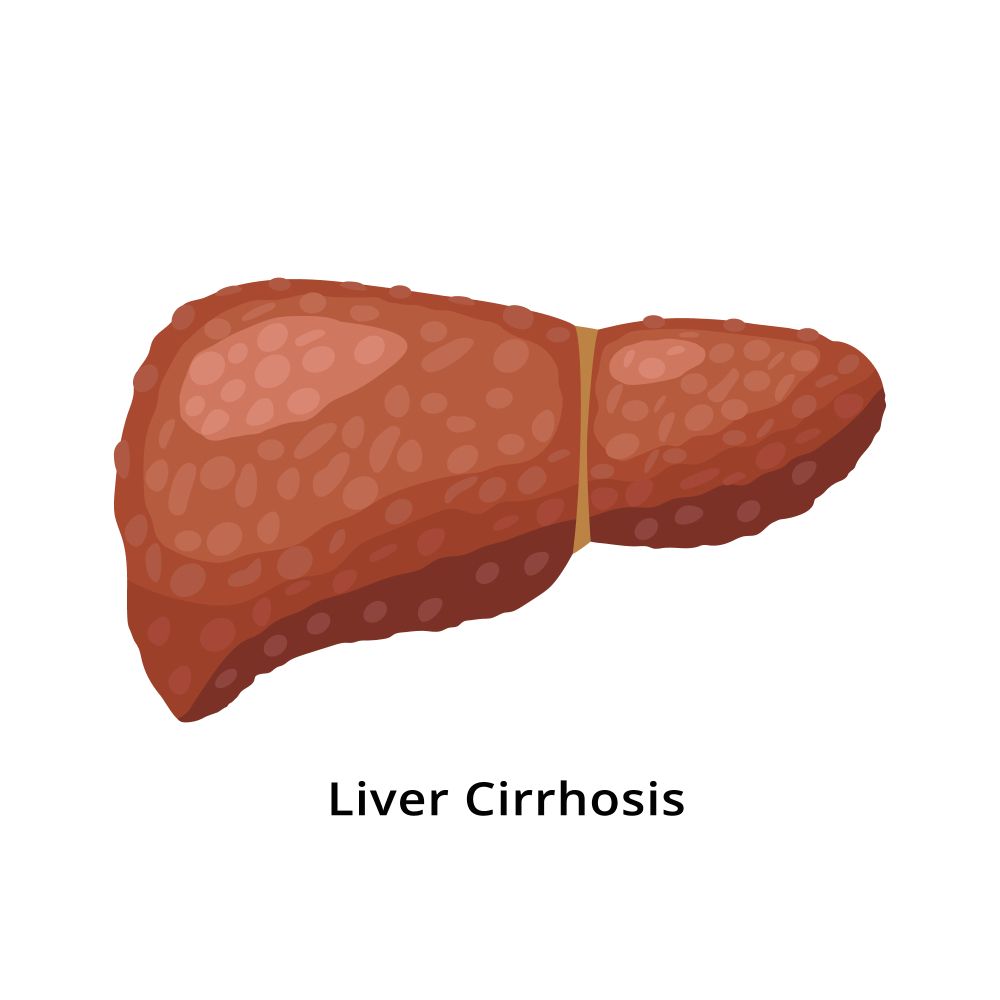 Liver Cirrhosis