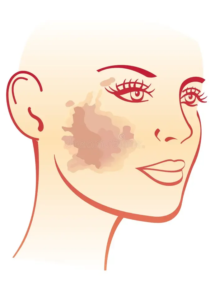 Melasma