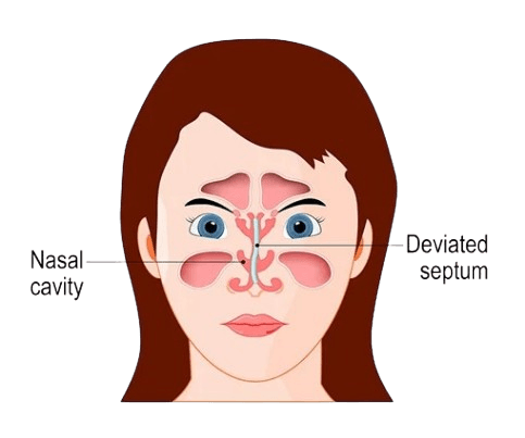 Deviated Septum