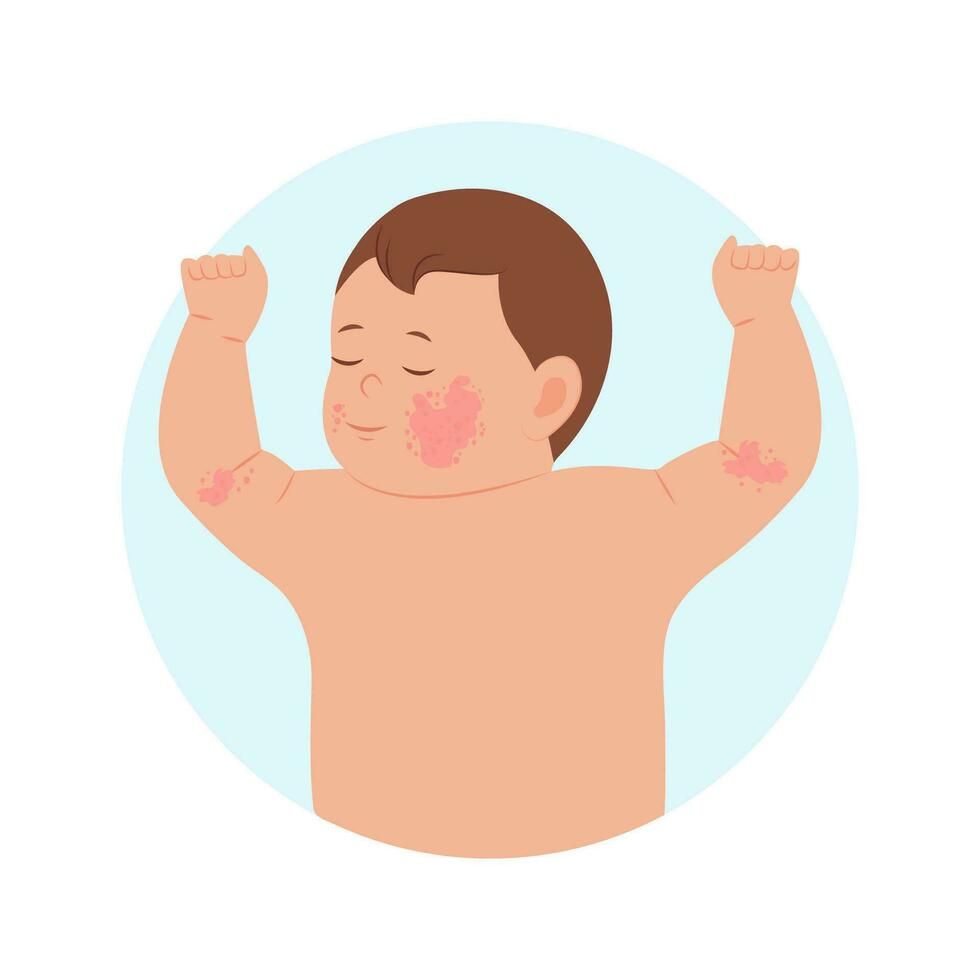 Pediatric Eczema in India