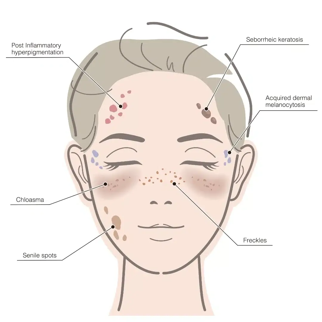 Post-Inflammatory Hyperpigmentation (PIH)