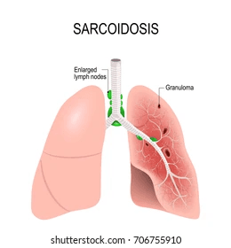 Sarcoidosis